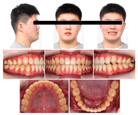 牙齒丟哪裡|牙齒掉了丟屋頂？ – 黃郁芩醫師 Orthodontics